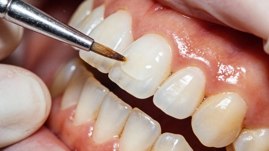 How much do veneers cost in Doha?