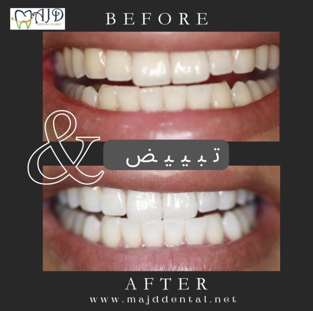 teeth whitening doha