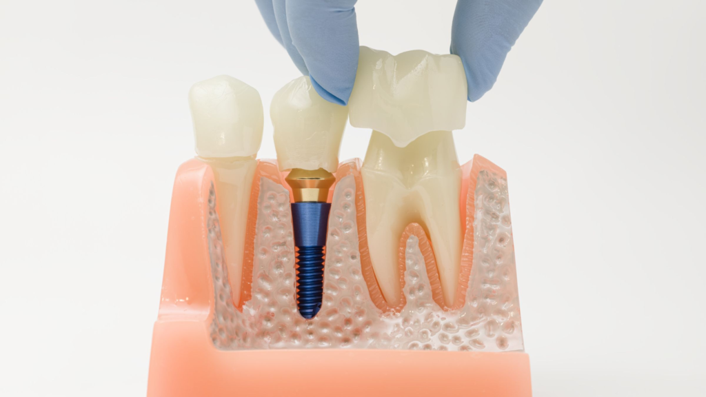 Dental crown price in Qatar: Full Guide