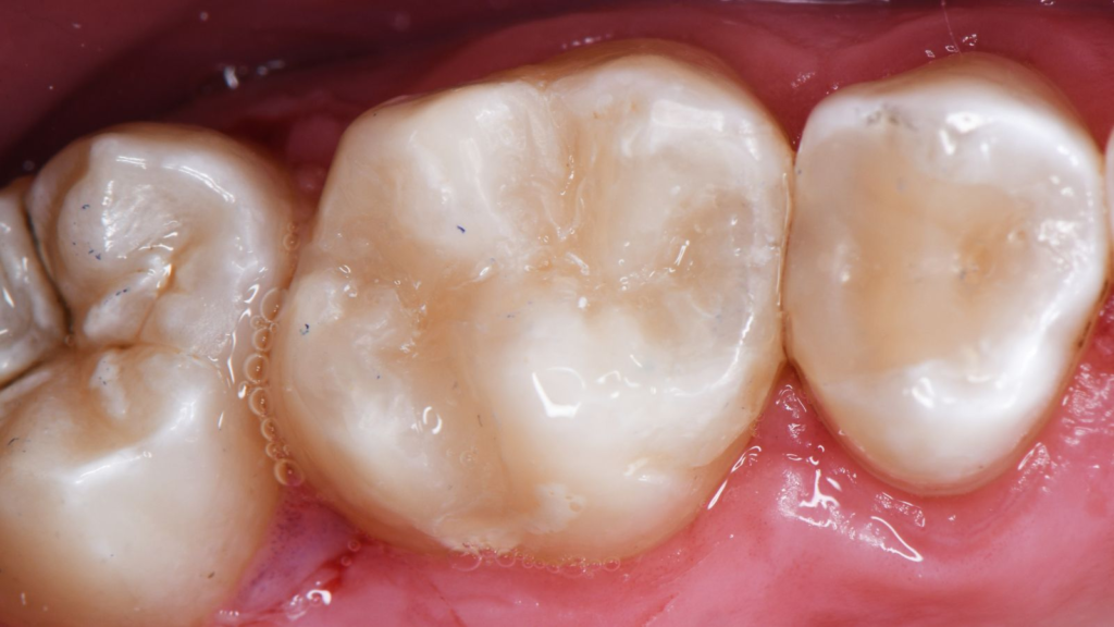 How much is composite bonding in Qatar?