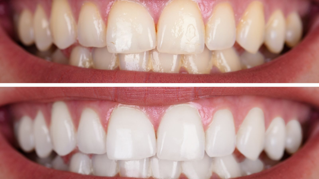 How much does it cost to whiten your teeth in Qatar?